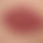 Hämangiom des Säuglings (Serie: Ausgangsbefund): &nbsp;
