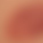 Hämangiom des Säuglings (Serie: Befund nach 2 Jahren):&nbsp; Keine Therapie, weitgehende Regressi...
