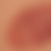 Hämangiom des Säuglings (Serie: Befund nach 2 Jahren):&nbsp; Keine Therapie, weitgehende Regressi...
