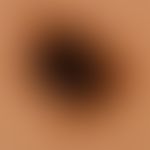 Nevus Spitz: reflected light microscopy of the previously clinically imaged nevus. irregular pigm...