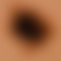 Nevus Spitz: reflected light microscopy of the previously clinically imaged nevus. irregular pigm...