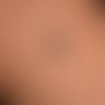 Naevus Spitz: a constantly growing, slightly raised, irregularly bordered, black-brown neoplasm, ...