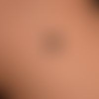 Naevus Spitz: a constantly growing, slightly raised, irregularly bordered, black-brown neoplasm, ...