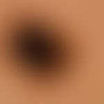 Nevus Spitz: Incident light microscopy of the previously clinically imaged nevus. Irregular pigme...
