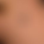 Differenzialdiagnose "malignes Melanom": hier abgebildet ein Spitz-Naevus (s.u. Spitz-Naevus) bei...
