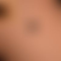 Differential diagnosis "malignant melanoma": here shown a Spitz nevus (see Spitz nevus below ) in...
