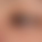 Molluscum contagiosum: ausgedehnter Befund bei bekannter Immundefizienz.

