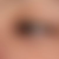 Molluscum contagiosum: ausgedehnter Befund bei bekannter Immundefizienz.
