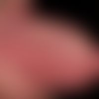 Rezidivierende Aphthen bei vorbekannter Colitis ulcerosa.&nbsp;
