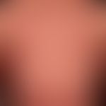 Sézary syndrome: universal redness with generalized lymphadenopathy; massive itching combined wit...