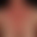 Intrinsic atopic eczema: chronic clinical picture with multiple, symmetrical, sharply defined, co...