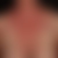 Intrinische&nbsp;atopische Dermatitis: chronisches Krankheitsbild mit multiplen, symmetrischen, s...