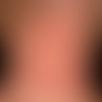 Atopic dermatitis: disseminated clinical picture with chronically stationary, blurred, itchy, rou...