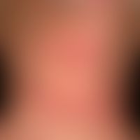 Atopische Dermatitis: disseminiertes Krankheitsbild mit&nbsp;chronisch stationären, unscharf begr...
