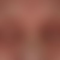 Atopische Liddermatitis:&nbsp;schwer verlaufende, chronische,&nbsp;persistierende, atopische Lidd...
