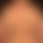 atopic dermatitis: eminently chronic dermatitis, with blurred, itchy, red, rough, flat plaques. k...