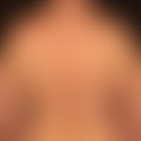 Atopische Dermatitis: eminent&nbsp;chronische dermatitis,&nbsp; mit unscharf begrenzten, juckende...