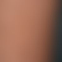 differential diagnosis "café-au-lait stain": diagnosis: becker nevus. hyperpigmented(border areas...