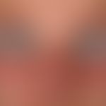 Lupus erythematodes kutaner: subakut-kutaner Lupus erythematodes&nbsp;
