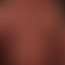 Poikilodermia vascularis atrophicans: 72-year-old patient with a slowly progressive, varicolored-...
