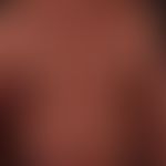 Poikilodermia vascularis atrophicans: 72 Jahre alter Patient mit seit > 15 Jahren bestehendem,...