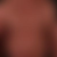 Poikilodermia vascularis atrophicans: 72 Jahre alter Patient mit seit > 15 Jahren bestehendem,...
