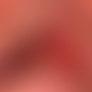 Mukositis orale: akute, schwere orale Mukositis mit flächenhafter, scharf begrenzter Erosion. &nb...