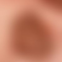 Keratose seborrhoische (papillomatöser Typ): Detailaufnahme
