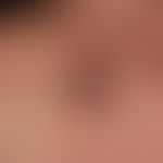 Keratose seborrhoische (papillomatöser Typ): brauner Knoten mit gelappter und gepunzter Oberfläch...