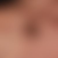 Keratose seborrhoische (papillomatöser Typ): brauner Knoten mit gelappter und gepunzter Oberfläch...