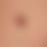 Keratosis seborrhoeic (papillomatous type): brown nodules with lobed and punched surface. sharp b...