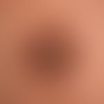 Keratosis areolae mammae bei einer paraneoplastischen Akrokeratose: erworbene, symptomlose,&nbsp;...