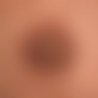 Keratosis areolae mammae in paraneoplastic acrokeratosis: acquired, symptomless, brownish verruco...
