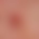 Keratosis actinica, keratotischer Typ: flächenhafte "Feldkanzerisierung" der Kopfhaut. Beginnende...