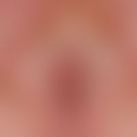 Lichen sclerosus der Vulva: flächige, nahezu homogene Sklerosierung der großen und kleinen Labien...