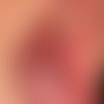 Lichen planus mucosae: white papules and plaques of the buccal mucosa, which condense at the end ...