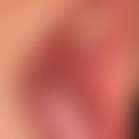 Lichen planus mucosae: white papules and plaques of the buccal mucosa, which condense at the end ...