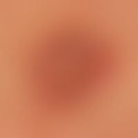 Lichen planus (klassischer Typ): seit mehreren Monaten&nbsp; persistierende, rote, juckende, poly...