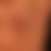 Lichen planus (classic type): for several months persistent, red, itchy, polygonal, partly conflu...
