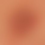 Lichen planus anularis:few, homogeneously filled, but also ring-shaped, moderately itchy, licheno...