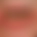 Differential diagnosis "Cheilitis actinica chronica" : in this case a lichen planus mucosae; espe...
