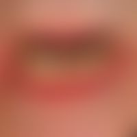 Differenzialdiagnose Cheilitis actinica chronica: 

Diagnose: vorliegend ein Lichen planus mucosa...