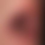 Lichen planus mucosae: a dissociative transformation of the lesions of the lichen planus on the l...
