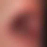 Lichen planus mucosae: a dissociative transformation of the lesions of the lichen planus on the l...