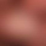 Lichen sclerosus of the penis: persistent lichen sclerosus for years with verrucous transformatio...