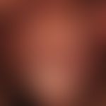 Lichen sclerosus of the penis: pronounced whitish, extensive sclerosing of the glans penis. prepu...