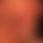 Lupus erythematodes chronicus discoides: seit 15 Jahren persistierende, progrediente Hautveränder...