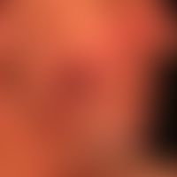 Lupus erythematodes chronicus discoides: persistent, progressive skin changes in a 67-year-old pa...