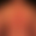 Lupus erythematodes chronicus discoides: seit mehreren Jahren bestehender, schubweise progredient...