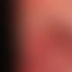 Differential diagnosis Lichen planus mucosae - present mucosal changes in systemic lupus erythema...